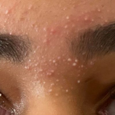 درمان جوش ابرو بعد از تاتو