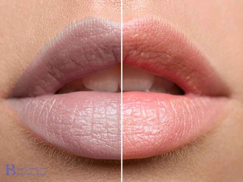 دلایل کبودی لب پس از شیدینگ