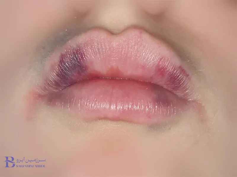 روش‌های پیشگیری کبودی لب بعد از شیدینگ