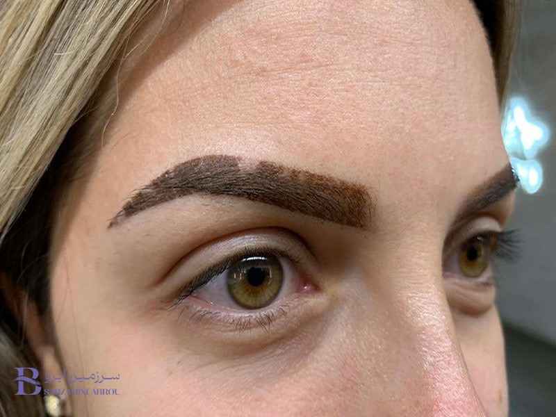 فیبروز ابرو چیست