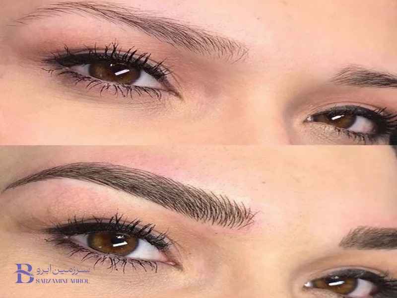 مراقبت‌های ضروری بعد از فیبروز